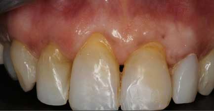 Dental Patient Suffering From Gum Recession, Gums Exposing Roots Of The Teeth