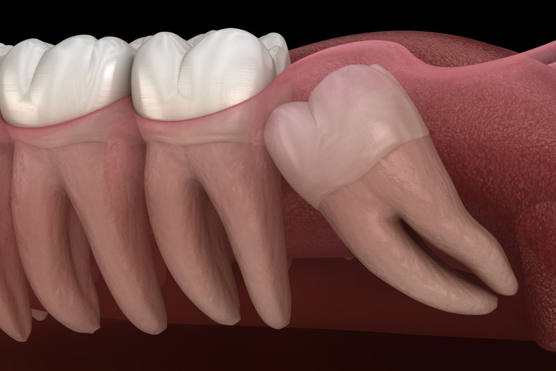 Wisdom Teeth Extraction In Harrisonburg Va Dr Saunders